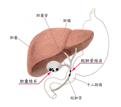 胆のう結石、総胆管結石