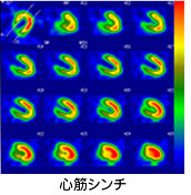 心筋シンチグラム