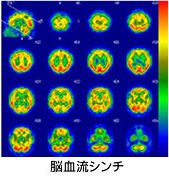 脳血流シンチグラム