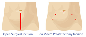 左：開腹手術の切開口  右：ダ・ヴィンチの切開口